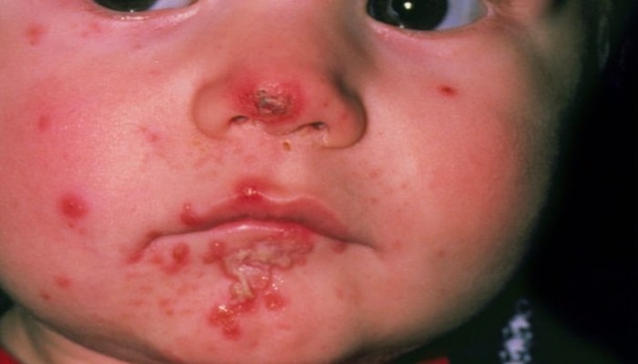Gambar Impetigo Gambar Impetigo