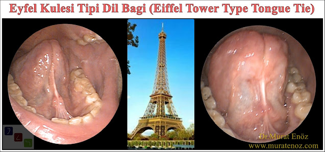 Eiffel Tower Type Tongue Tie - Eiffel Tower Type Anterior Tongue Tie - Eiffel Tower Type Lingual Frenulum - Tongue Tie Istanbul - Tongue Tie Turkey - Tongue Tie Relase Operation