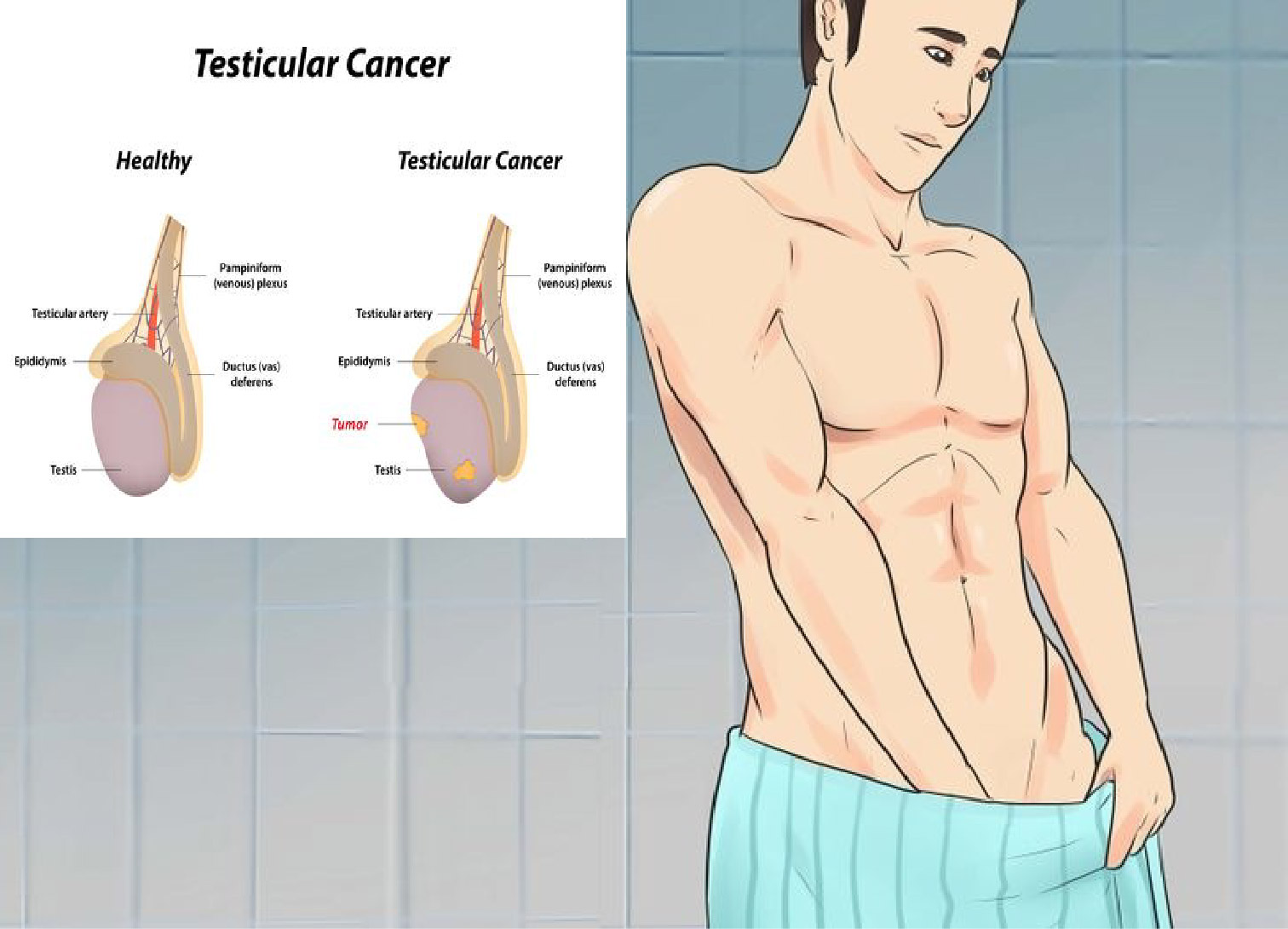 testicular cancer 