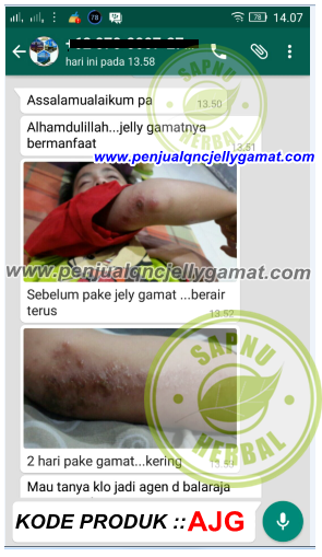 Obat Eksim Kering Dan Basah, 100% Terbukti Ampuh Menyembuhkan Eksim Kering dan Basah Obat Eksim Kering Dan Basah, 100% Terbukti Ampuh Menyembuhkan Eksim Kering dan Basah