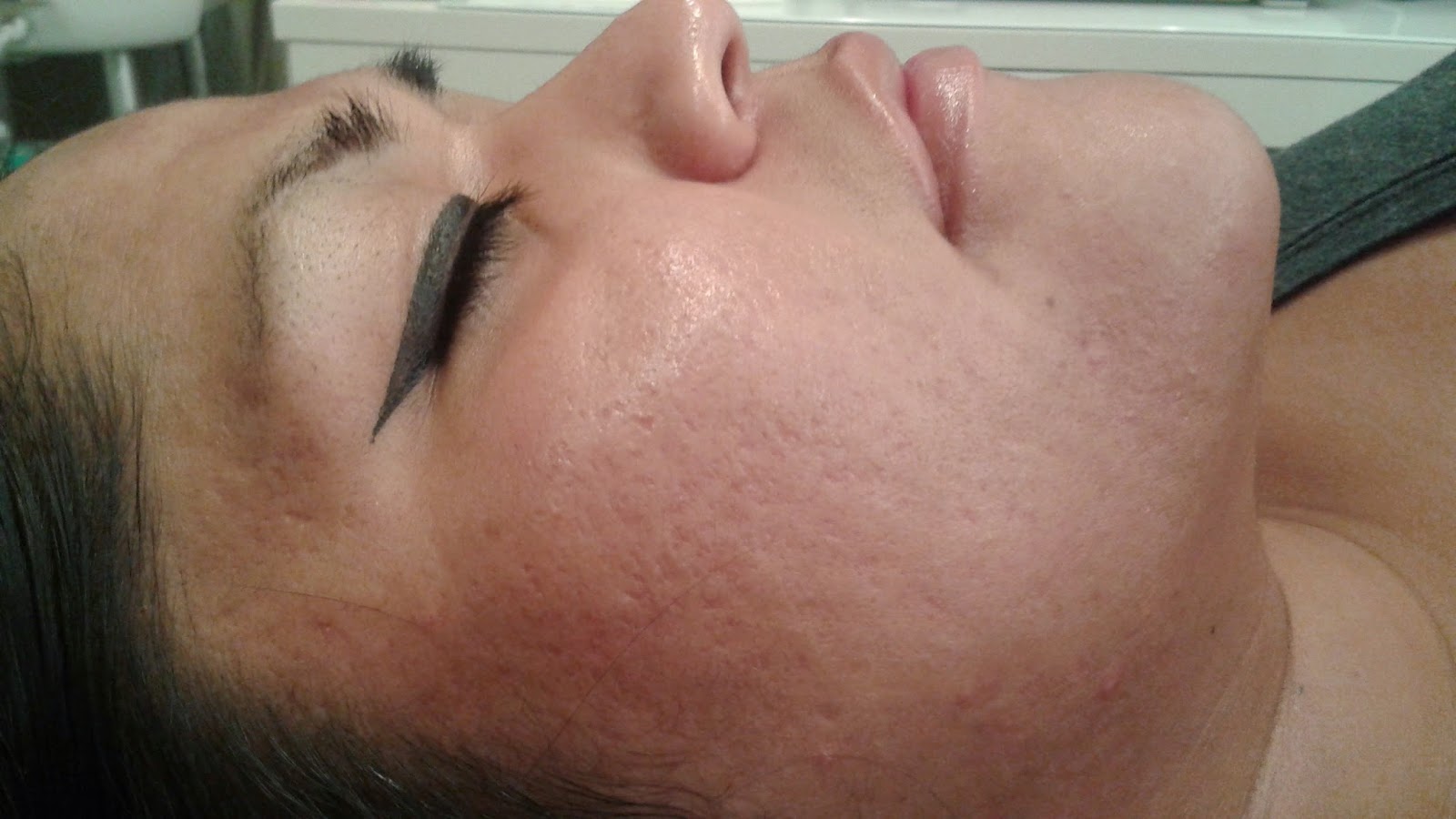 acne scar treatments in Utah