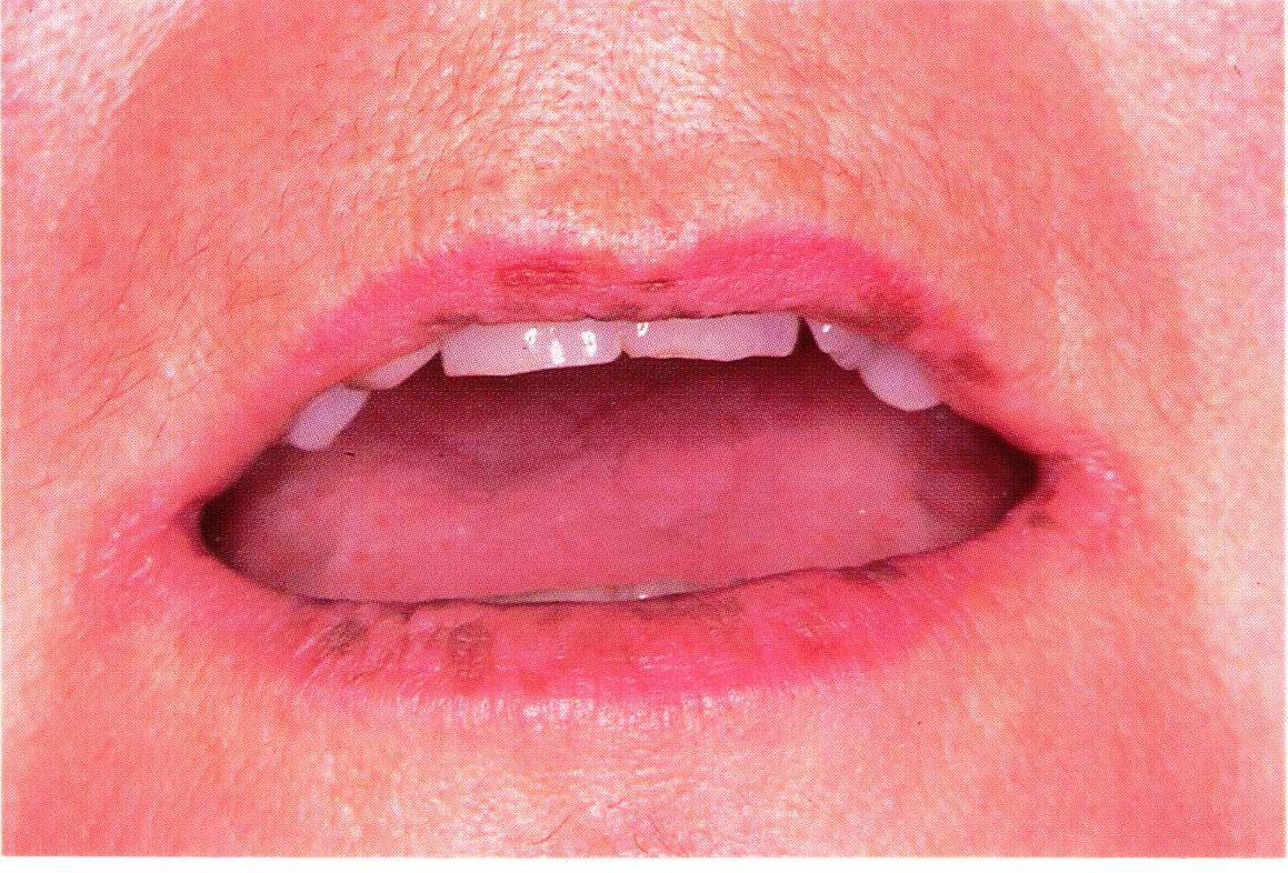 Lip Biopsy: Overview, Indications, Contraindications