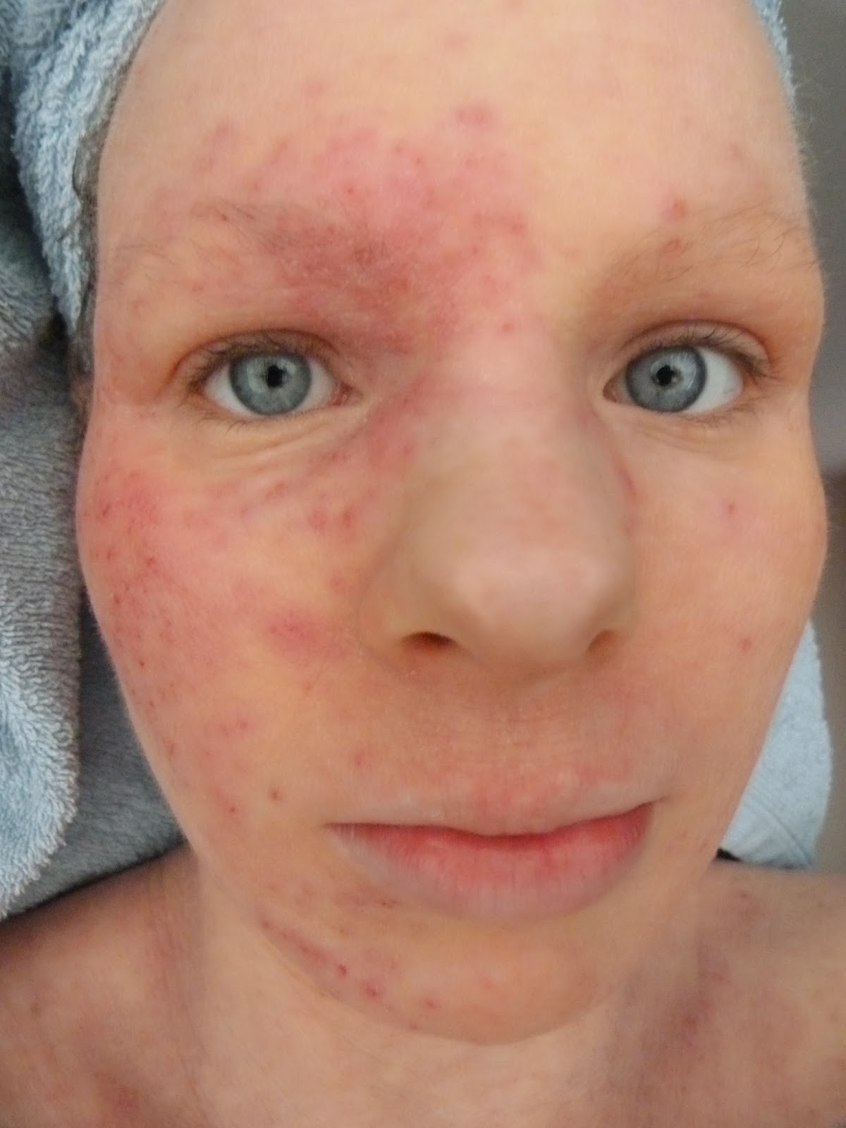 I Have Eczema Eczema Herpeticum Round 9