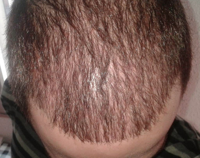 Pastillas para la alopecia difusa