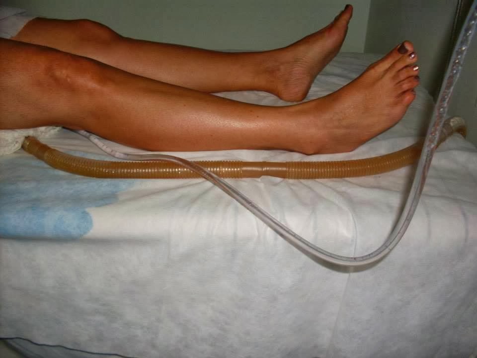 HIDROCOLONTERAPIA: Hidrocolonterapia: entenda o procedimento