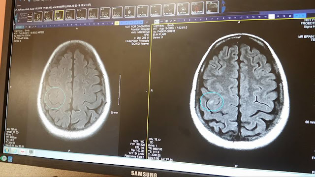 brain MRI, MRI, Li Fraumeni, LFS, lifraumeni, freckle, spot, lesion, froedtert, lexapro, help, anxiety, stress, depression