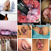 Obat Hemorrhoid (Wasir, AmbeYen, Piles) thumbnail