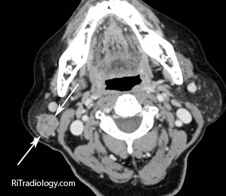 parotid mass ct gland right radiology tumor warthin solid neck year woman who old