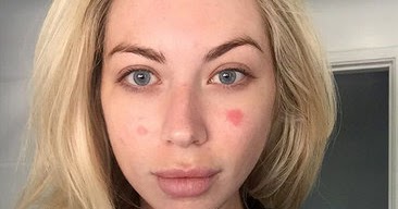 Stassi Schroeder Opens Up About Her Battle With Psoriasis With Makeup ...