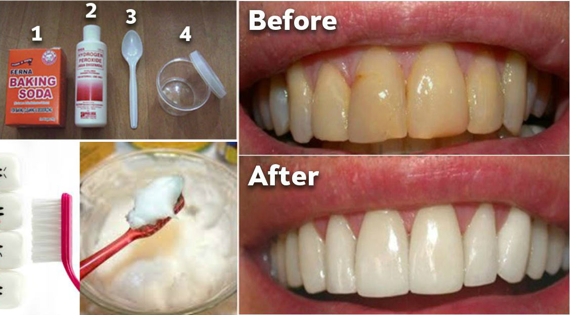 how-to-remove-plaque-from-teeth-without-expensive-treatments-it-s-easy