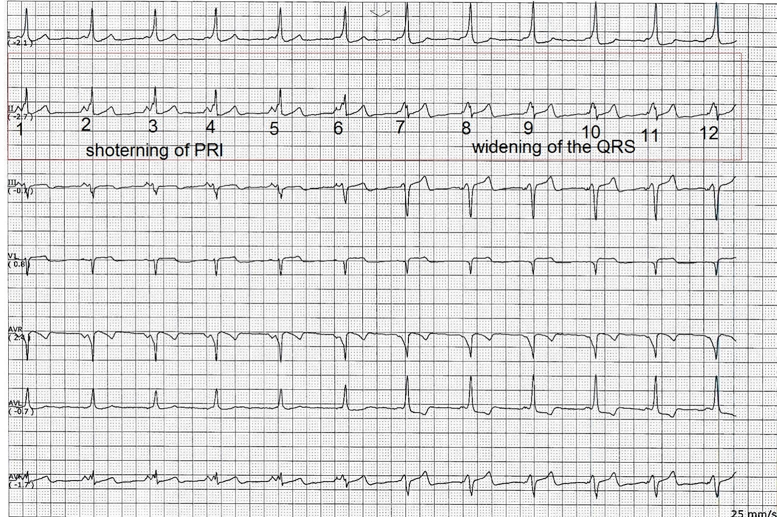 ECG Rhythms The Concertina Effect of Preexcitation