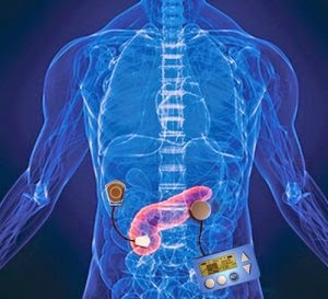 páncreas biónico para la diabetes tipo 1 páncreas biónico para la diabetes tipo 1