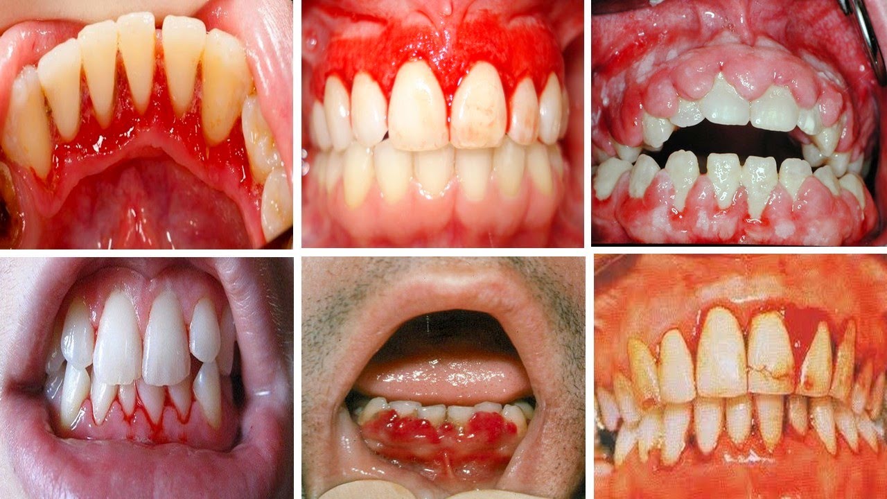 العلاج بالنباتات علاج خراج اللثة والأسنان بالطب البديل