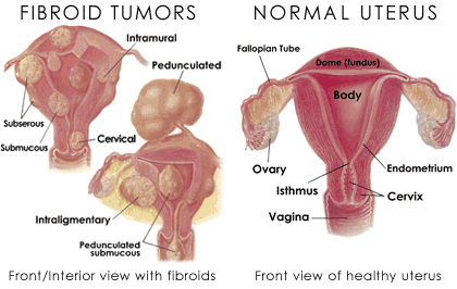 All what you need to know about Fibroids! | BETA GIRLS ORGANIZATION