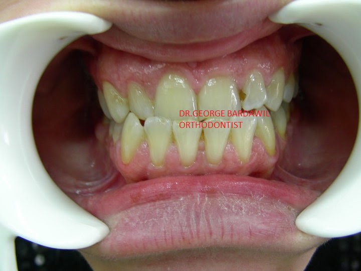 Dr.George E. Bardawil-Orthodontist-Invisalign Diamond level : CLASS 3