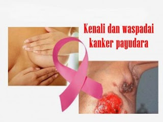 kanker payudara bertahan hidup, kanker payudara stadium 1 sampai 4, kanker payudara peraboi, kanker payudara yg pecah, menyembuhkan kanker payudara secara alami, cara membuat ramuan obat kanker payudara, kanker payudara jurnal, kanker payudara stadium 4 sembuh dengan propolis, gejala awal pada kanker payudara, cara mengobati kanker payudara laki laki, obat herbal untuk mengatasi kanker payudara, obat herbal khusus kanker payudara, kanker payudara grade ii, pengobatan gejala kanker payudara, cara mengobati kanker payudara dengan kulit manggis, penyembuhan kanker payudara stadium 1, obat-obat untuk kanker payudara, kanker payudara dan kanker serviks, obat untuk kanker payudara stadium akhir, daun herbal untuk kanker payudara, alat untuk mengobati kanker payudara, obat kimia kanker payudara, buah yg mengobati kanker payudara, obat herbal alami kanker payudara, kanker payudara adalah pdf, obat tradisional kanker payudara 2011, pengobatan kemoterapi kanker payudara