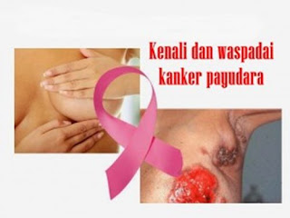 Kanker Payudara Dan Ibu Menyusui, Obat Kanker Payudara Alami, Kanker Payudara Ciriciri, Kanker Payudara Stadium 1 Bisa Sembuh, Kanker Payudara Sembuh Tanpa Operasi, Kanker Payudara Menurut Who Tahun 2011, Pengobatan Kanker Payudara Stadium 2, Kanker Payudara Rumah Sakit Dharmais, Obat Penyakit Kanker Payudara Alami, Obat Herbal Kanker Payudara Stadium 3, Cara Pengobatan Kanker Payudara Stadium 3, Obat Herbal Untuk Gejala Kanker Payudara, Gejala Awal Kanker Payudara Pada Wanita, Obat-Obatan Untuk Kanker Payudara, Epidemiologi Kanker Payudara Di Indonesia, Faktor Penyebab Kanker Payudara Pada Pria, Pengobatan Kanker Payudara Stadium Lanjut, Obat Alami Kanker Payudara Murah, Obat Kemo Untuk Kanker Payudara, Kanker Payudara Facebook, Cara Pengobatan Kanker Payudara Stadium 1, Kanker Payudara Wanita, Kanker Payudara Laki2, Obat Tradisional Pengobatan Kanker Payudara, Kanker Payudara Metastase Tulang, Ciri Kanker Payudara Pada Pria, Kanker Payudara Terminal, Cara Mengobati Kanker Payudara Yang Masih Kecil, Pengobatan Alternatif Kanker Payudara Stadium 2, Pengobatan Kanker Payudara Jinak, Obat Penyakit Kanker Payudara Alami, Klinik Herbal Kanker Payudara, Obat Kanker Payudara Yang Sudah Pecah