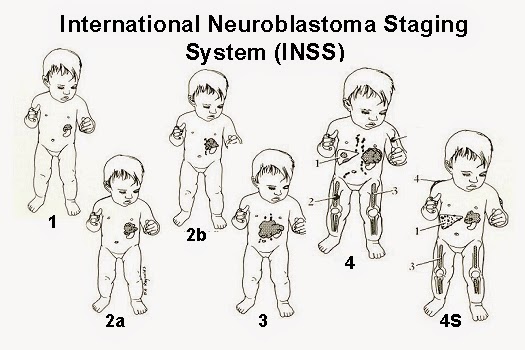 Neuroblastoma adalah kanker sistem saraf pada anak