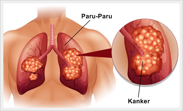 Obat Kanker Paru-Paru Terbaik Herbal Obat Kanker Paru-Paru Terbaik Herbal
