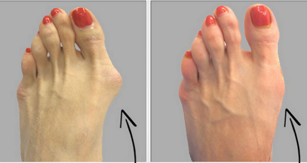 How To Get Rid Of Gout In Big Toe Naturally How To Get Rid Of Gout In Big Toe Naturally