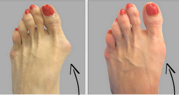 How To Get Rid Of hallux valgus Or Onion Feet Naturally