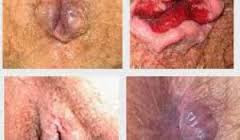 Foto Salep Manjur Benjolan di Sekitar Anus Bengkak