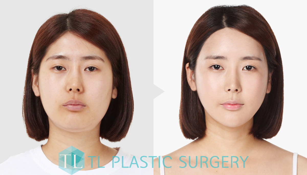 Potong lemak wajah ! Power V! TL PS Lifting Indonesia