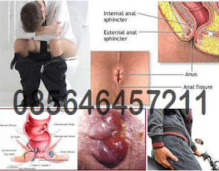 Apakah Penyakit Wasir Luar Bisa Sembuh Total Apakah Penyakit Wasir Luar Bisa Sembuh Total