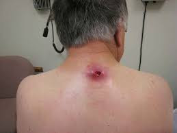  sebaceous cyst