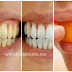 BE YOUR OWN DENTIST! HERE ARE TRICKS TO REMOVE TARTAR BUILDUP AT HOME