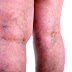 Varicose Veins and Its Causes-gregoryhealthworld.com