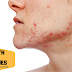 Major Causes Of Acne Which You Doesn't Know