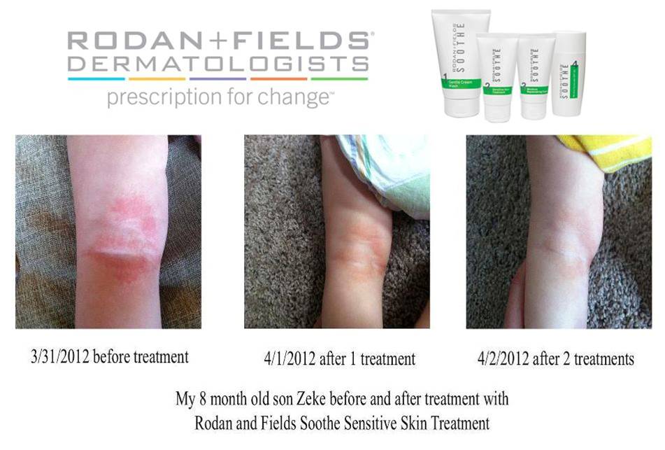 the brown bunch Soothe regimen Before/After..REAL results!