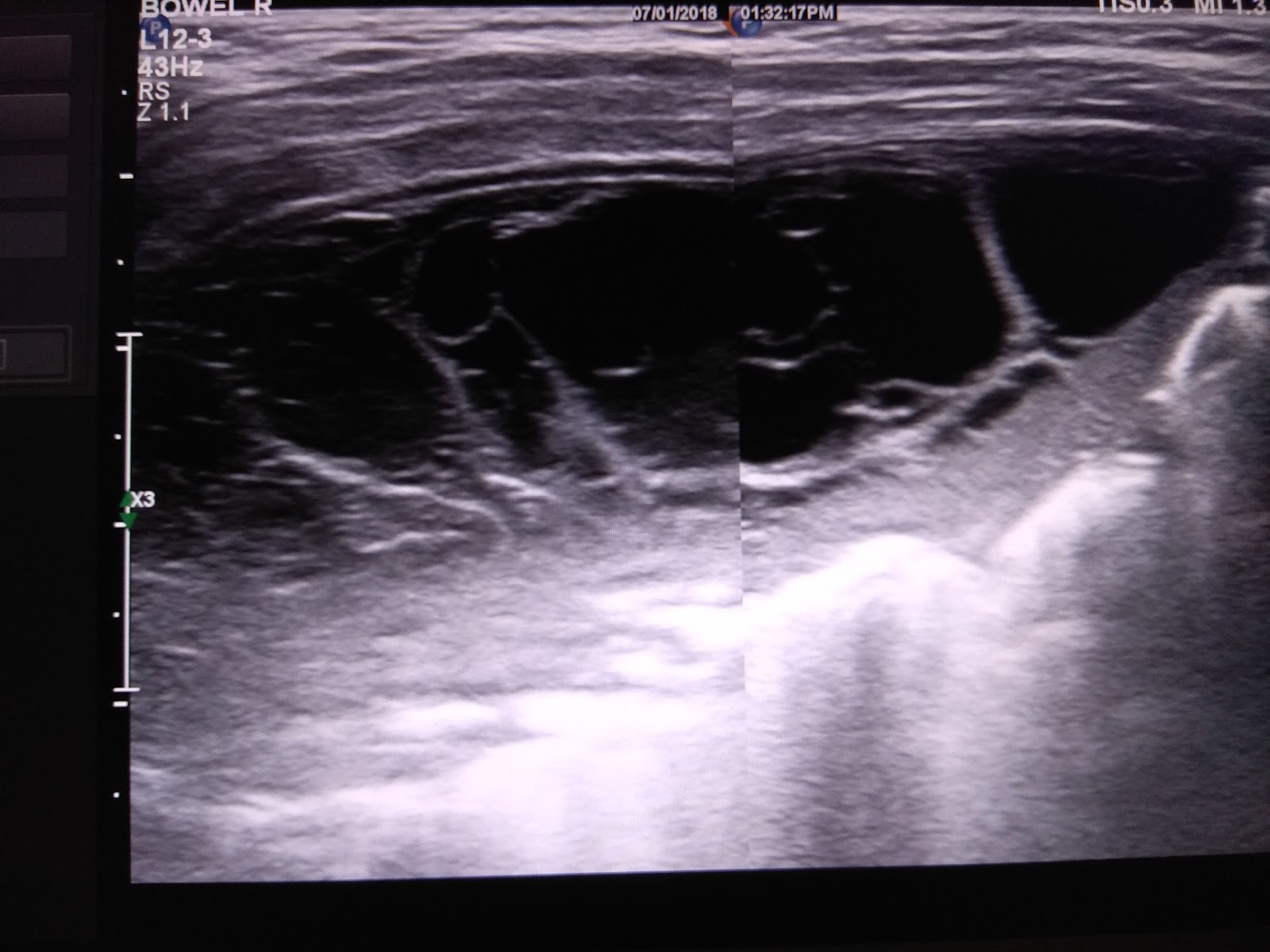 SONO DIGEST ULTRASOUND CHEST Empyema thoracis & Enlarged Thymus