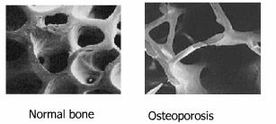 comparison-between-normal-and-osteoporotic-bone
