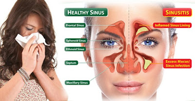 infeksi sinus infeksi sinus