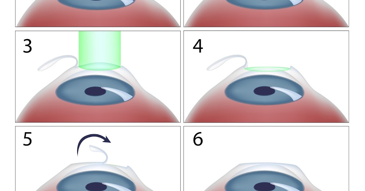 Коррекция зрения методом смайл. Лазерная коррекция зрения ласик. Лазерная операция на глаза Фемто ласик. Лазерная коррекция методом Фемто ласик. Этапы операции super LASIK.