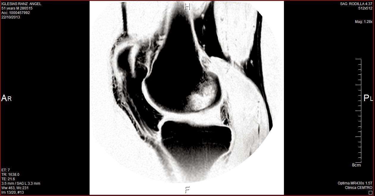 edema oseo l4-l5