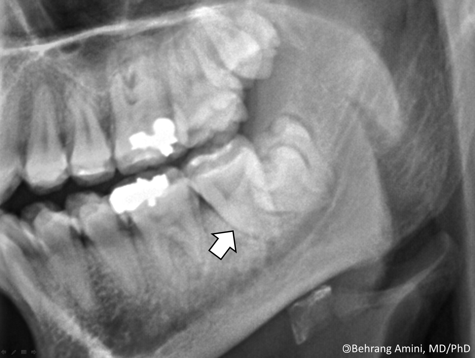 Roentgen Ray Reader Radiographic Features of Hyperparathyroidism