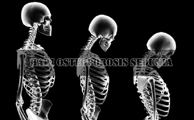 Asal Mula Hari Osteoporosis Sedunia Asal Mula Hari Osteoporosis Sedunia
