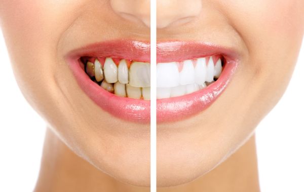 La placa acumulada provoca la inflamación de encías y daño dental