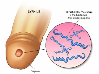 Daftar Obat Tradisional Untuk Menghilangkan Bakteri Sipilis Super Ampuh Obat%2Bsiiipilis%2Braja%2Bsinga