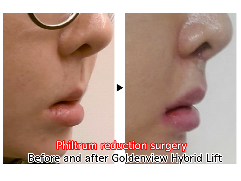 Goldenview Plastic surgery lip lift, lips surgery , phitrum surgery, k