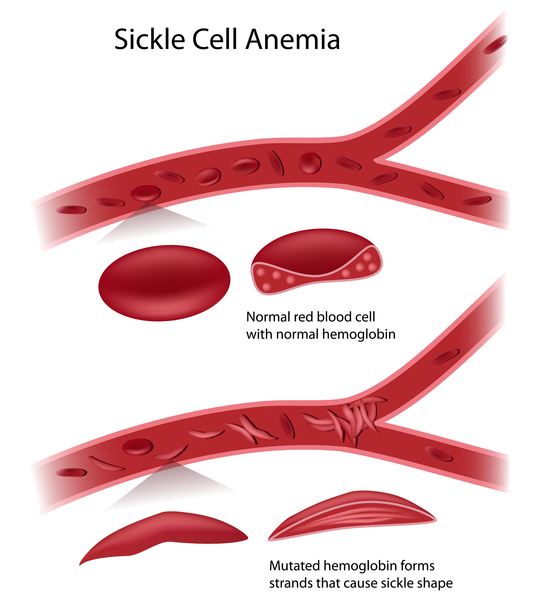 Asian forms of sickle cell Asian forms of sickle cell
