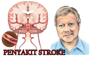Pantangan Makanan Untuk Penderita Stroke Terlengkap Pantangan Makanan Untuk Penderita Stroke Terlengkap