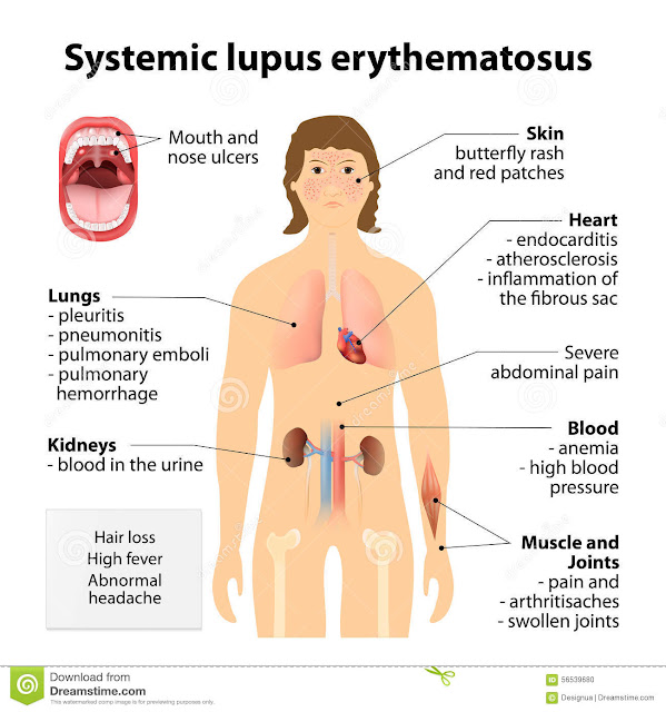 Fotos de lupus eritematoso sistemico