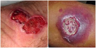 Obat Luka Borok Bernanah Dan Berair, Menyembuhkan Luka Borok Bernanah dan Berair Sampai Sembuh Total Obat Luka Borok Bernanah Dan Berair, Menyembuhkan Luka Borok Bernanah dan Berair Sampai Sembuh Total