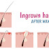 INGROWN HAIR TREATMENT - Ways to Get Rid of Ingrown Hair