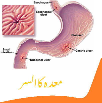 Best Food To Prevent Stomach Cancer Best Food To Prevent Stomach Cancer