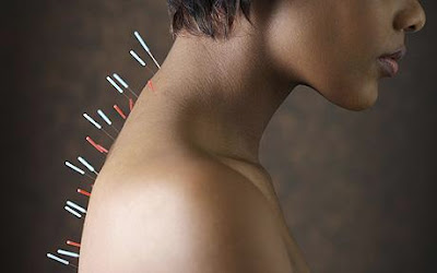 Acupuncture’s benefits Acupuncture’s benefits